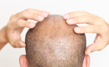 毛髪のお悩みに AGA治療