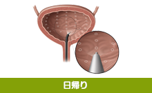 難治性の過活動膀胱に ボトックス膀胱壁内注入治療